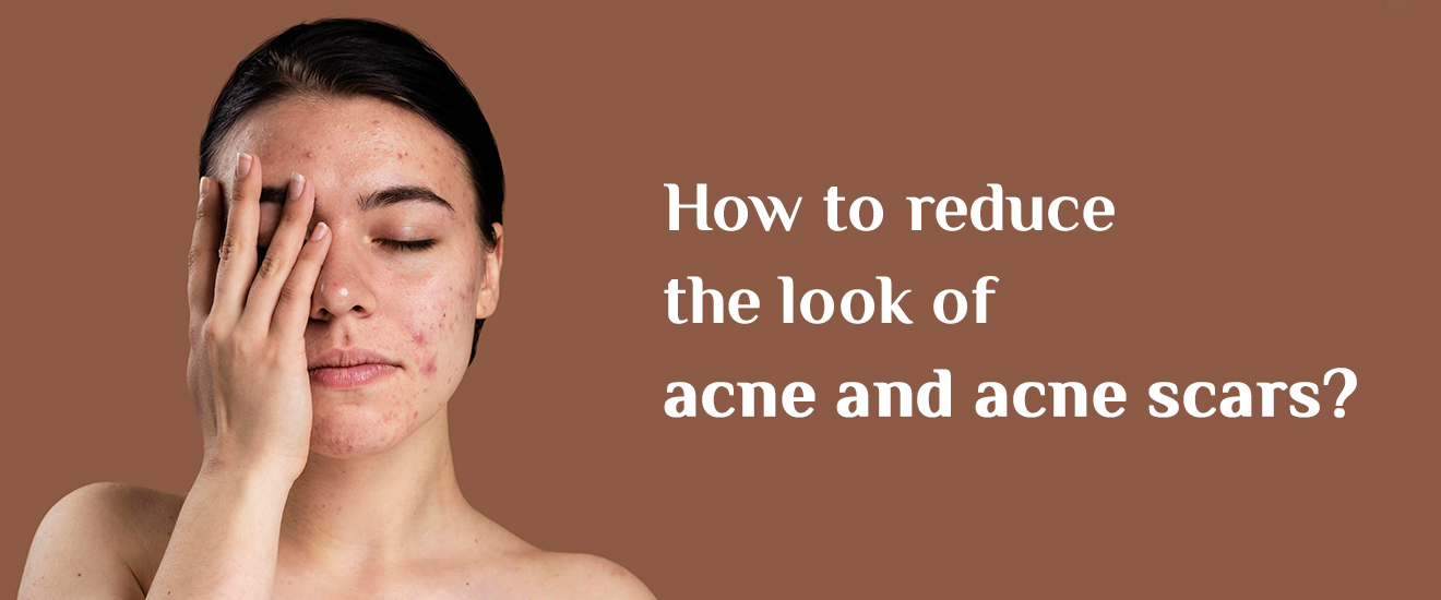 How To Reduce The Look Of Acne And Acne Scars
